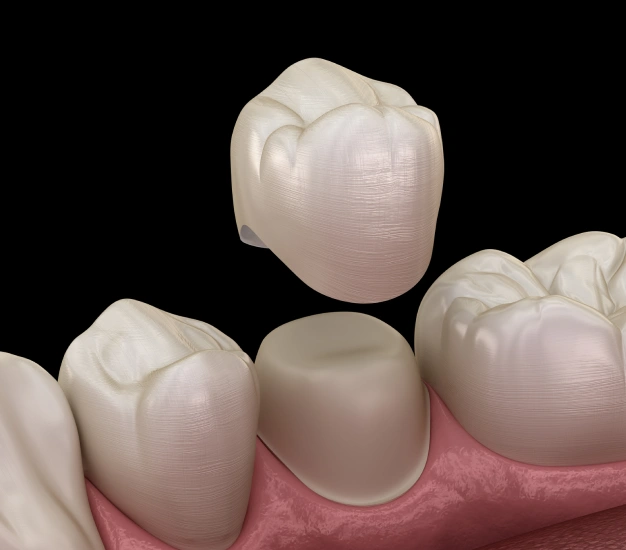 Dental Crowns