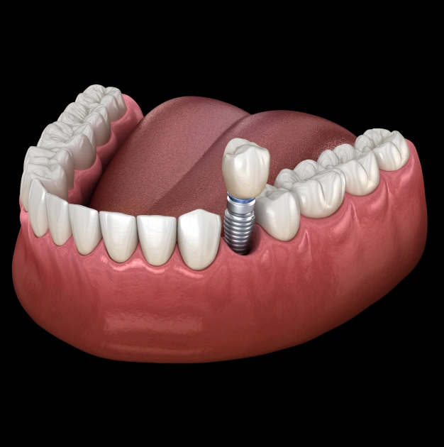Dental Implants